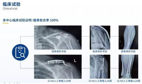 中国有五个，2022全球骨科器械十大事件